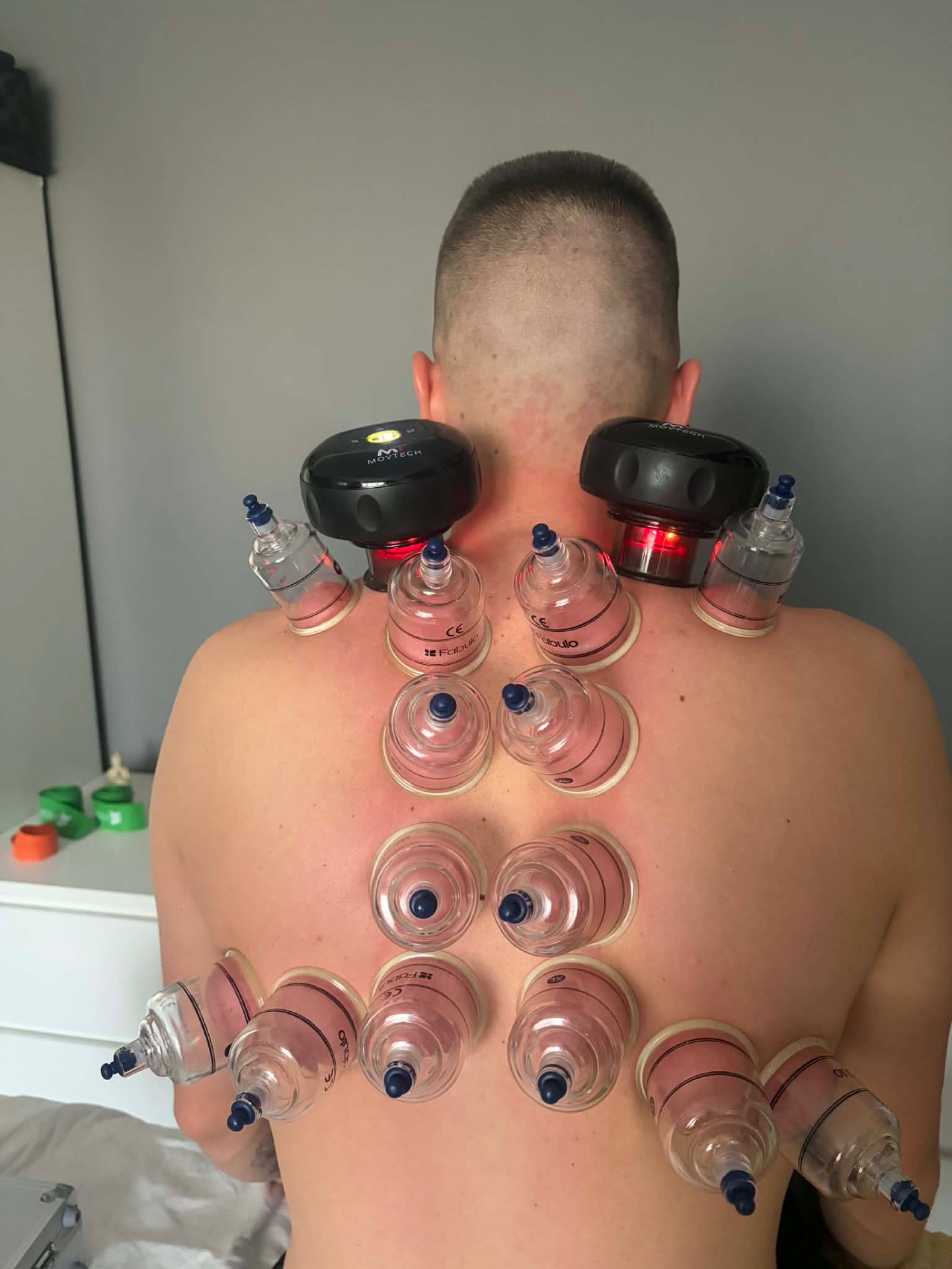 Köpölyözés